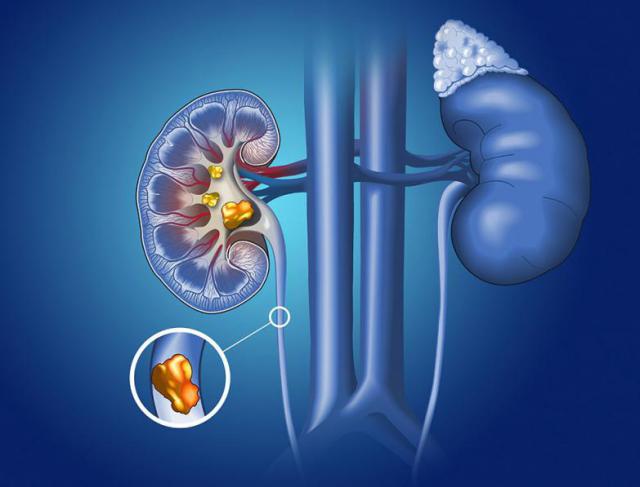 CÁLCULO RENAL OU PEDRA NOS RINS